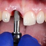implantologia dentale roma