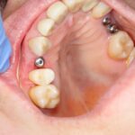 implantologia dentale vermicino