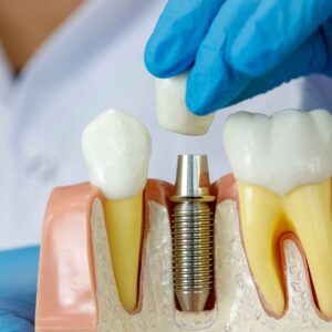 implantologia dentale tuscolana